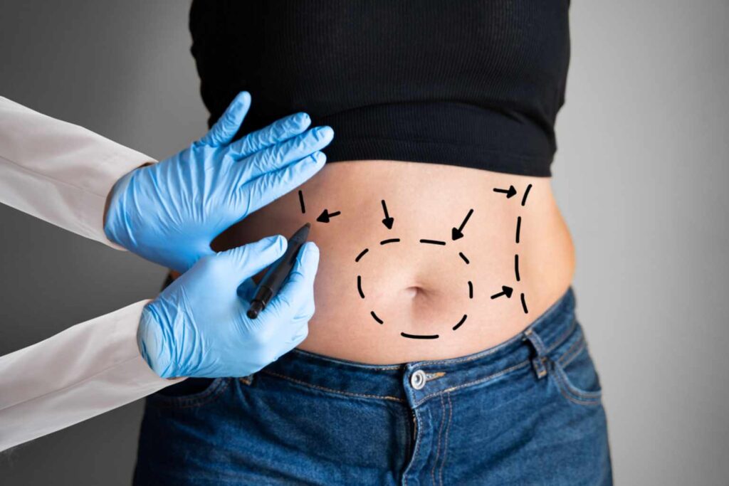 abdominoplastie
