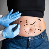 Calea către o talie de viespe: totul despre abdominoplastie