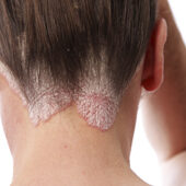 Trateaza psoriazisul pe cale naturala