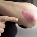 Psoriazis