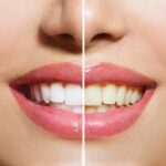 Cum pastram culoarea alba a dintilor?
