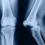 Depunerile de calciu: cauze si tratament
