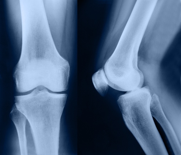 Calcificare la nivelul genunchului - Tratament de entezopatie a genunchiului