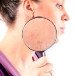 Ten uscat sau acneic? Afla remediile naturiste comune!