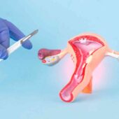 cancer de col uterin