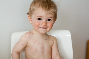 Bolile Infecto Contagioase Ale Copilariei