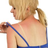 Arsuri solare? Iata cele mai eficiente tratamente naturale!