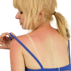 Arsuri solare? Iata cele mai eficiente tratamente naturale!