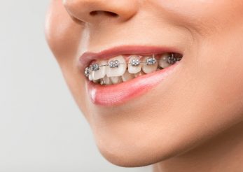 Aparatul dentar – trend sau nevoie?