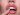 faţetele dentare