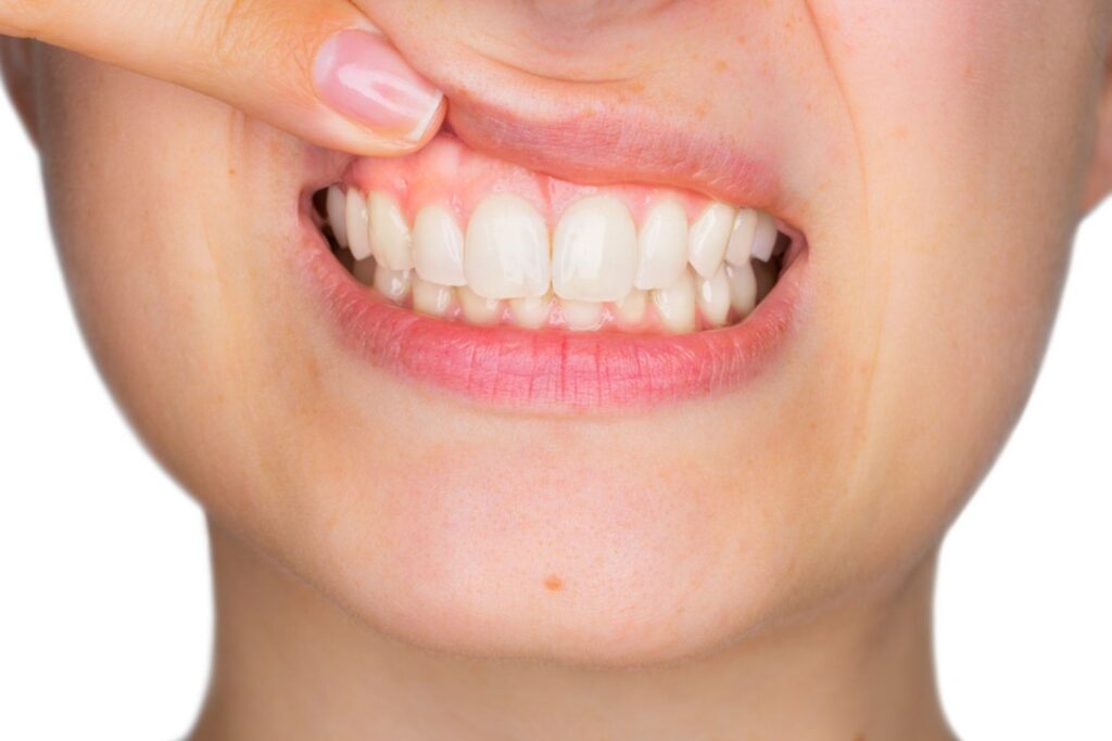 Ce boli trădează culoarea gingiilor