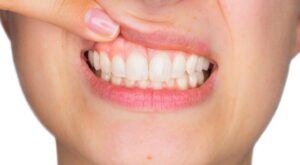 Ce boli trădează culoarea gingiilor