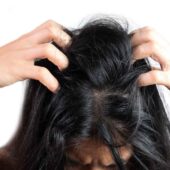 scalp seboreic