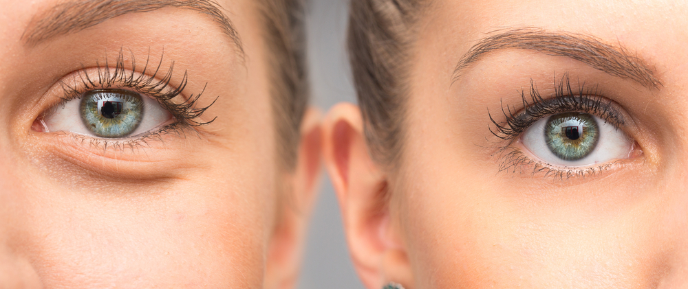 blefaroplastie